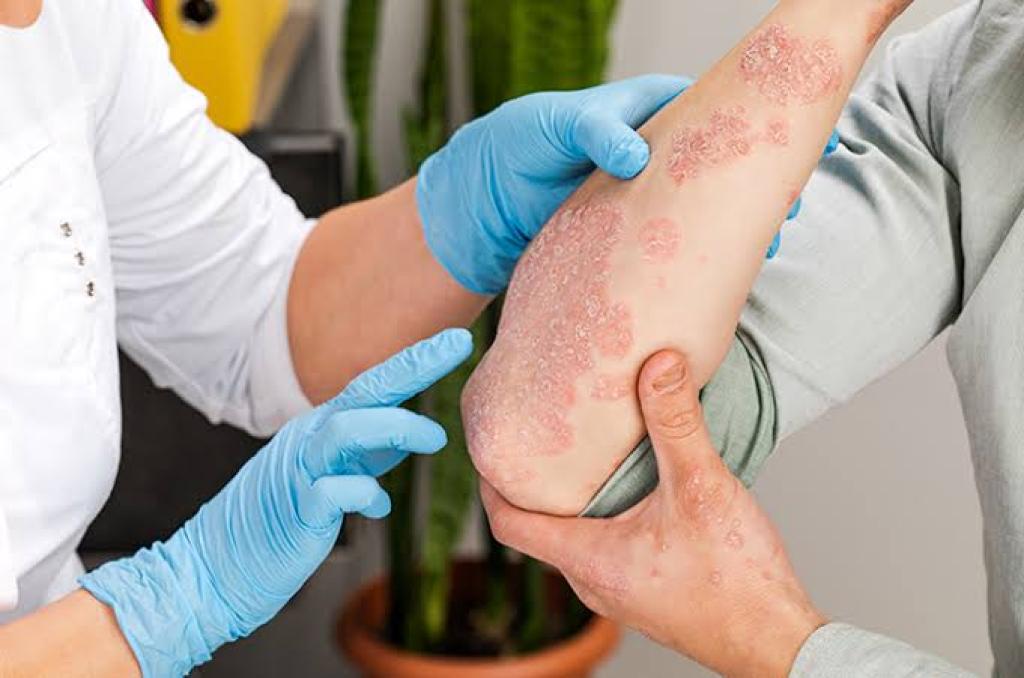 Bintan Raih Status Bebas Penyakit Frambusia dari Kemenkes RI